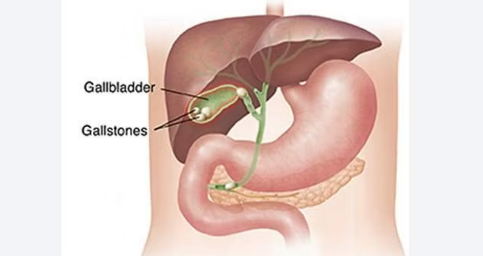 பெண்ணின் பித்தப்பையிலிருந்து 1000 கற்கள் அகற்றி மருத்துவர்கள் சாதனை!