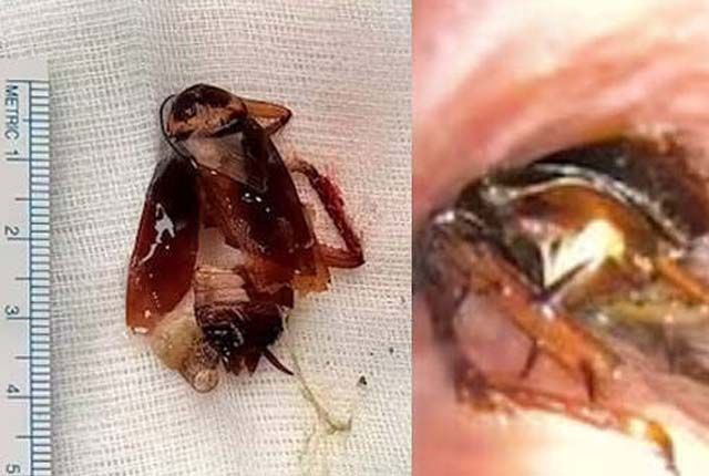 மனிதனின் நுரையீரலில் இருந்து எடுக்கப்பட்ட கரப்பான் பூச்சி.