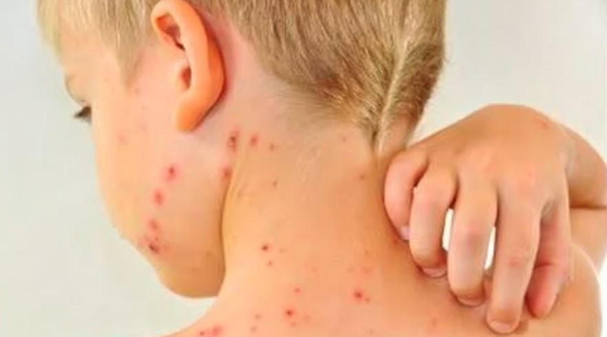 கேரளத்தில் 75 நாள்களில் 6,744 பேருக்கு அம்மை நோய் பாதிப்பு, 9 பேர் பலி