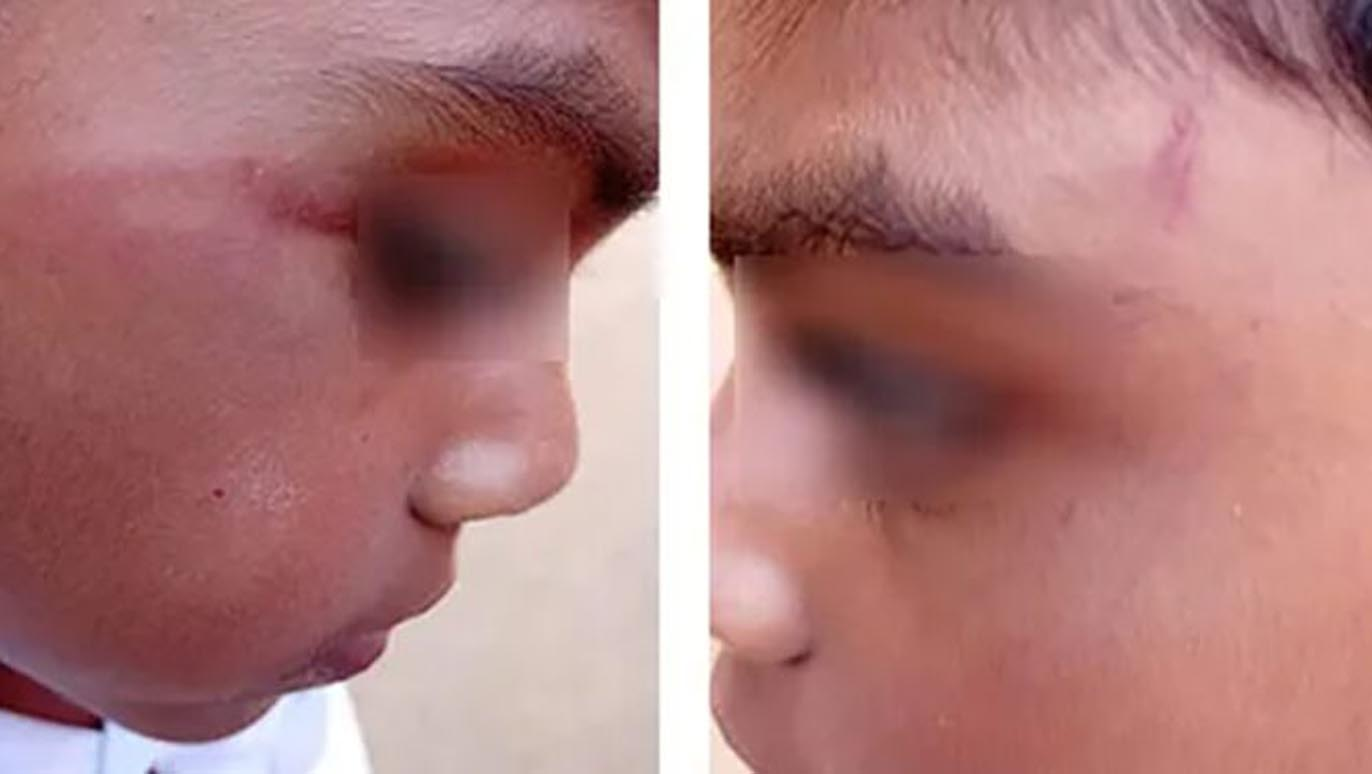 பாடம் மறந்த மாணவனை கொடூரமாக தாக்கிய ஆசிரியை கைது.