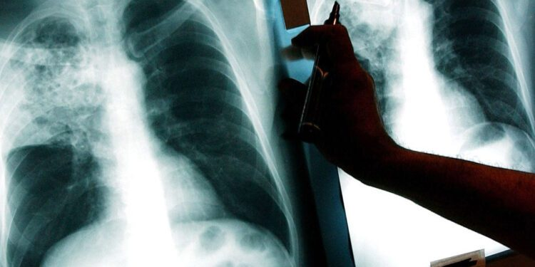 யாழ்ப்பாணத்தில் உள்ள பிரபல ஆண்கள் பாடசாலையில் 05 மாணவர்களுக்கு காசநோய்.