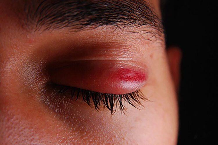 தரமற்ற மருந்துகளால் பார்வை இழந்தவர்களுக்கு அரச இழப்பீடு.