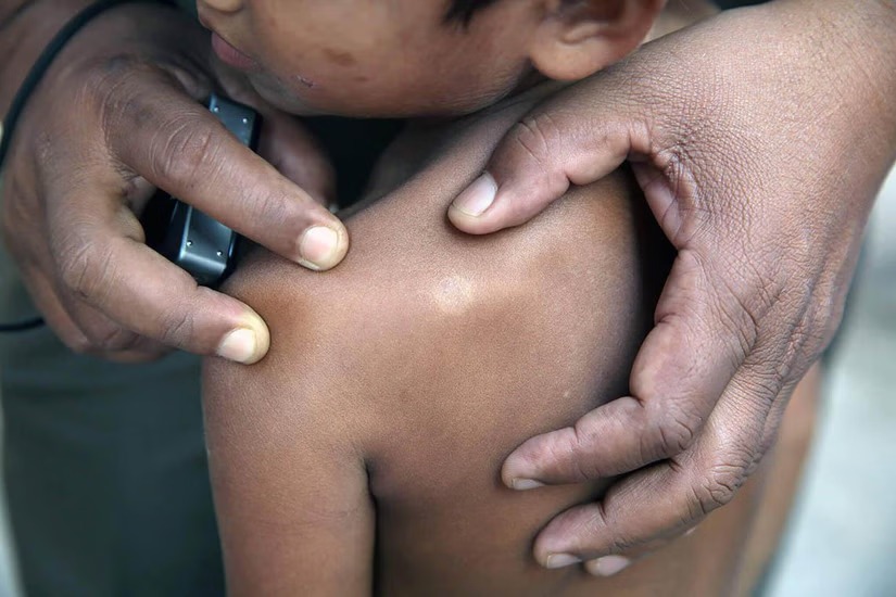 இலங்கையில் தொழுநோய் பரவல்; பாதிக்கப்பட்டோரில் 12% சிறுவர்கள்