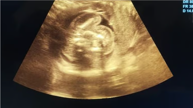 மகாராஷ்டிரத்தில் ஓர் கர்ப்பிணிப் பெண்ணிற்கு அரிய வகையான ‘கருவினுள் கரு’ எனும் நிலை உண்டாகியிருப்பதை கண்டுபிடித்த மருத்துவர்கள்!