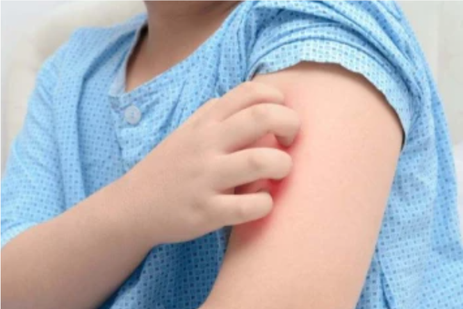 தமிழகத்தில்   கோடை காலங்களில் குழந்தைகளை தாக்கும் தக்காளி காய்ச்சல் தொடர்பில் எச்சரிக்கை