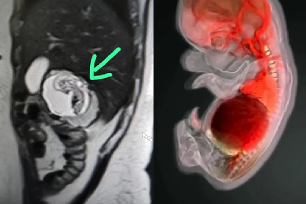 இந்தியாவில் முதல் முறையாக பெண் ஒருவருக்கு கல்லீரலில் கரு வளர்ந்த அதிர்ச்சி சம்பவம்!