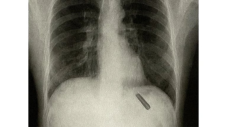 அதிசயமான அறுவை சிகிச்சை: 26 ஆண்டுகளாக நுரையீரலில் இருந்த பேனா மூடி அகற்றம்!