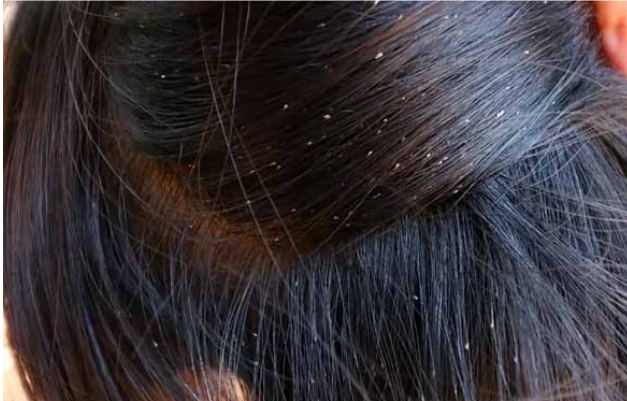 பேன் தொல்லையால் பறிபோன 6-ம் வகுப்பு மாணவியின் உயிர்! ஒடிசாவில் நிகழ்ந்த விபரீத சம்பவம்.