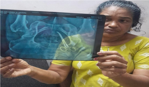 5 ஆண்டு கால வயிற்று வலி: எக்ஸ்ரே பார்த்த மருத்துவர்கள் அதிர்ச்சி – வயிற்றுக்குள் இருந்த ‘கத்தரிக்கோல்’!