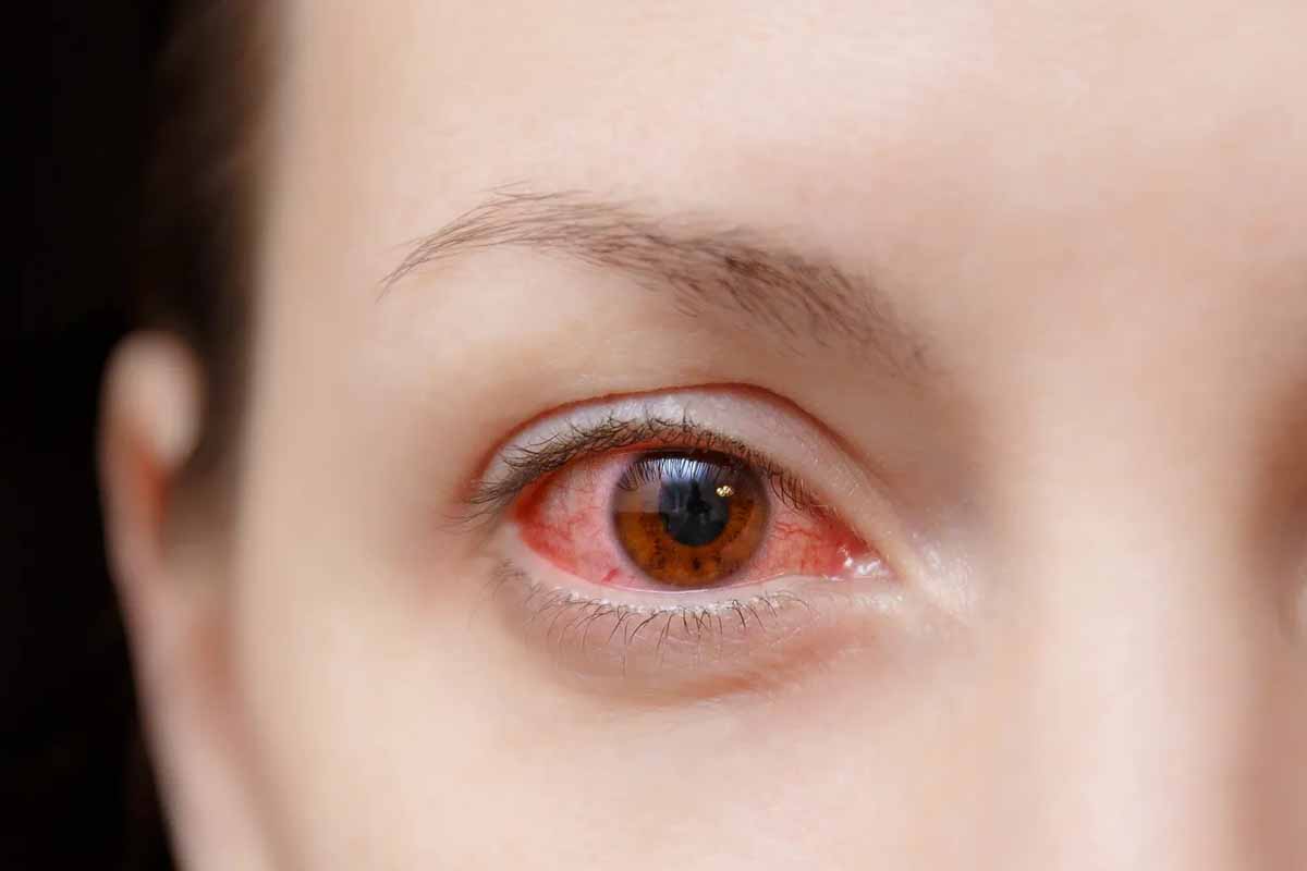 தமிழகத்தில் ‘மெட்ராஸ் ஐ’ விஸ்வரூபம்: கோடை தொடக்கத்திலேயே தீவிரமாகப் பரவும் கண் தொற்று!